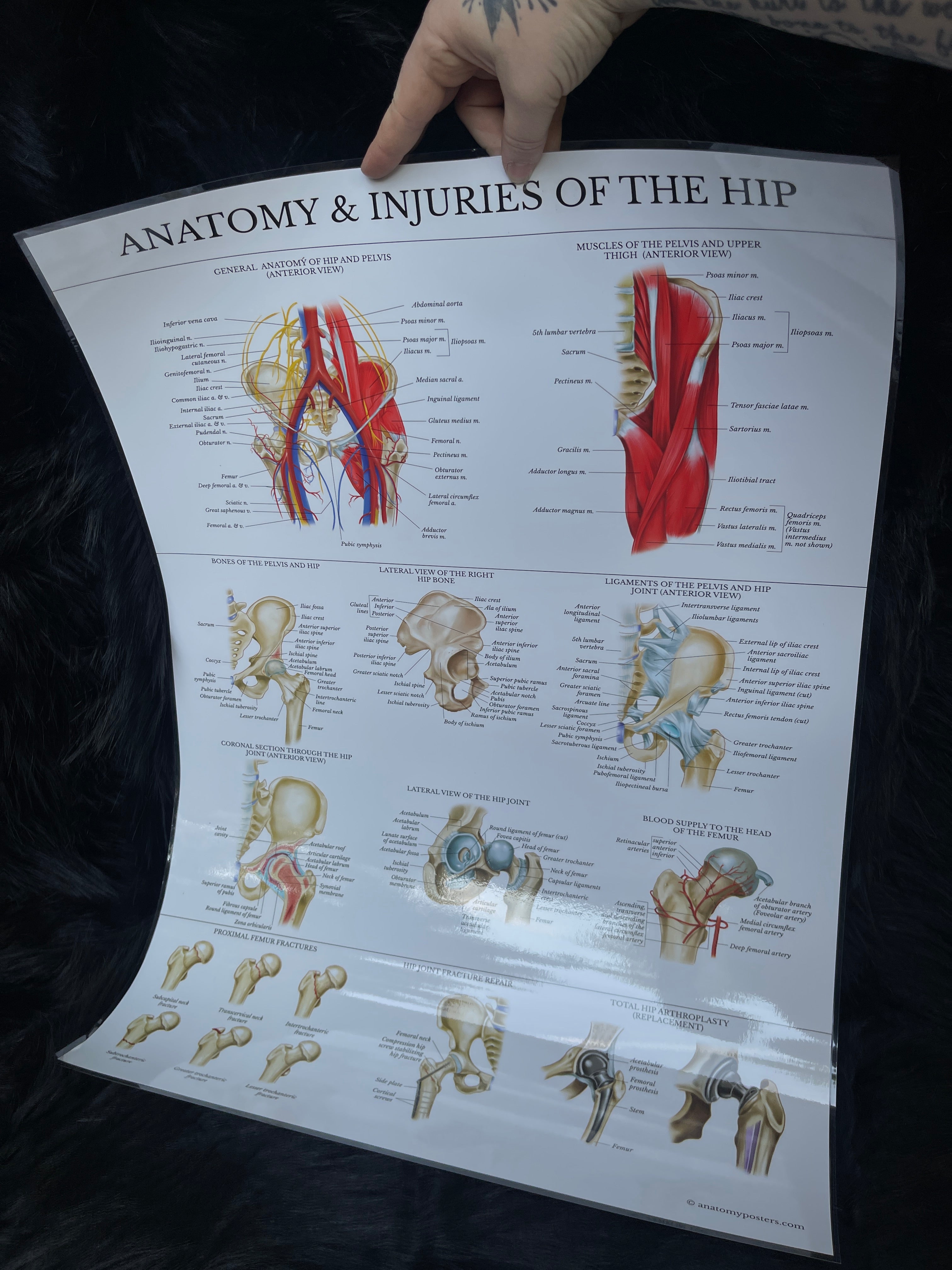 *Modern* Laminated Double Sided Anatomy & Injuries of the Hip / Dermatomes Poster